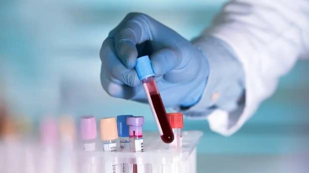 Вчені створили тест, який може виявити рак за 10 років до появи симптомів