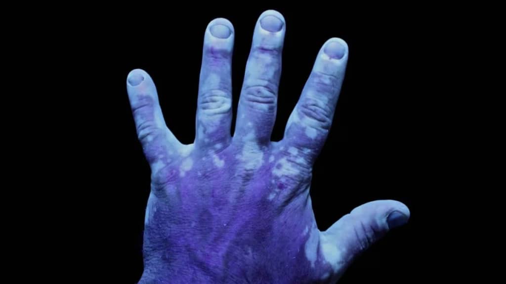 Вітіліго: чому люди з цією хворобою досі стикаються з осудом