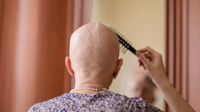 Ліки від артриту відновлюють до 100% волосся у пацієнтів з важкою алопецією