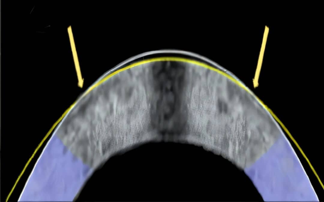 Альтернатива LASIK обіцяє покращити зір без скальпеля та лазерів