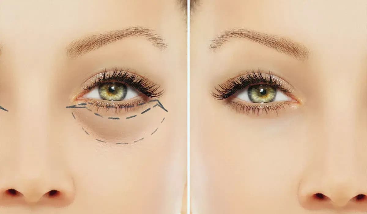 Блефаропластика – погляд, який відкриває нові можливості