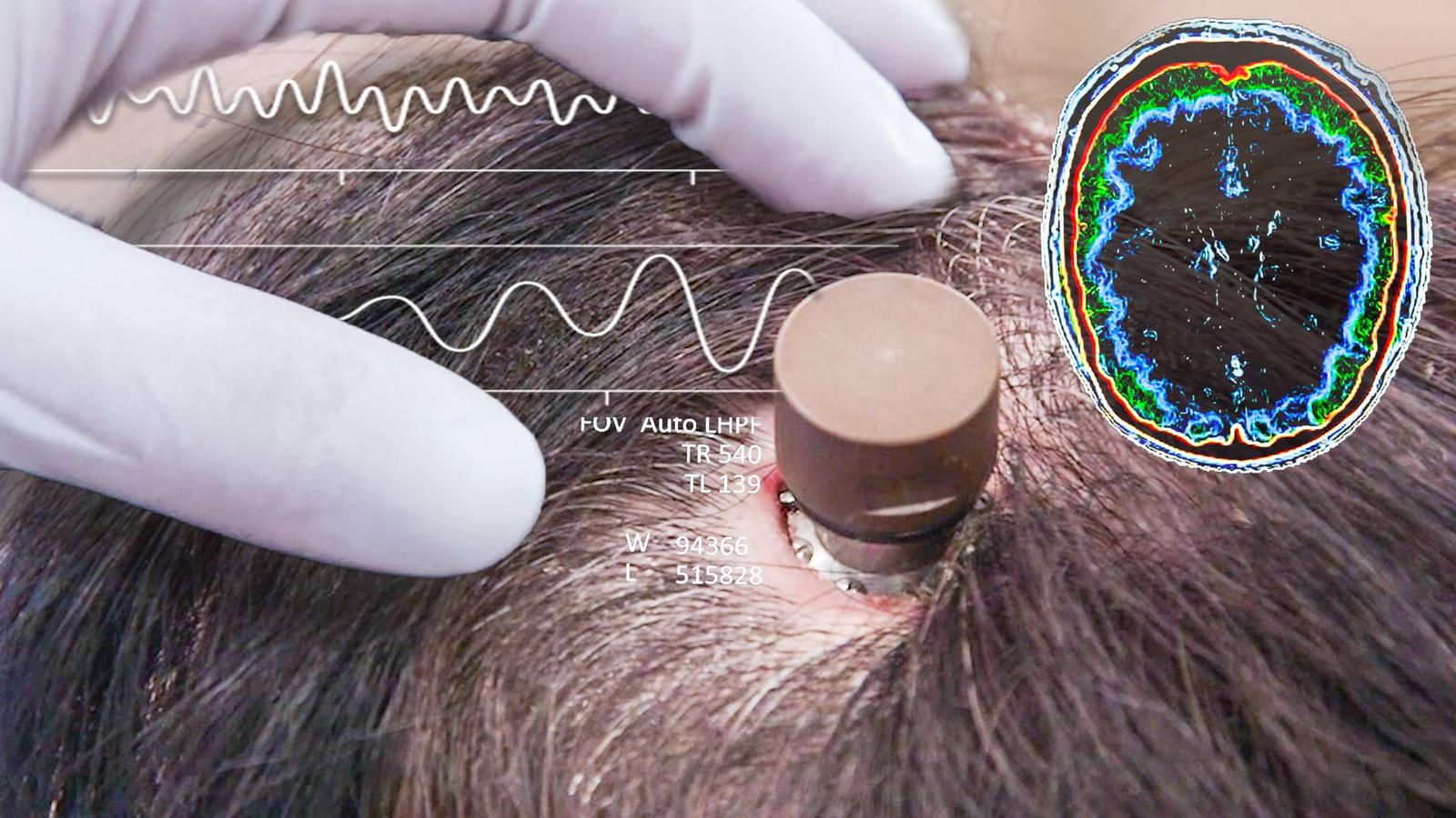 Neuralink вперше вживили в мозок людини: він дозволяє керувати будь-яким пристроєм силою думки