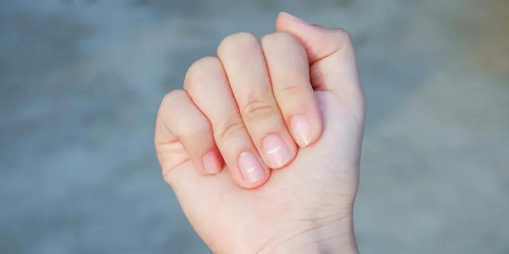 Чому на нігтях з’являються білі точки та смужки