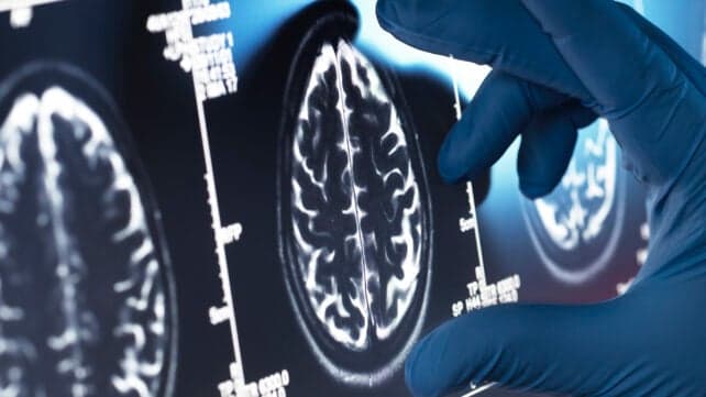 Дослідження показало, що препарати для лікування хвороби Альцгеймера не приносять значної користі