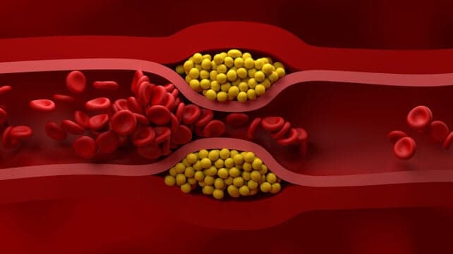 Нові рекомендації кардіологів США щодо управління холестерином