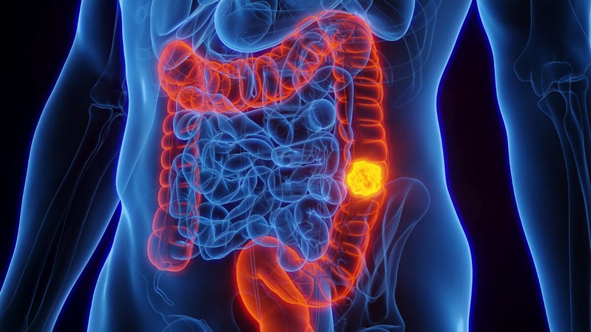 Мікроби кишечника можуть пояснити, як західна дієта сприяє раку товстої кишки