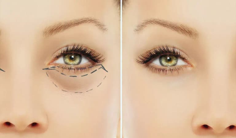 Блефаропластика – погляд, який відкриває нові можливості