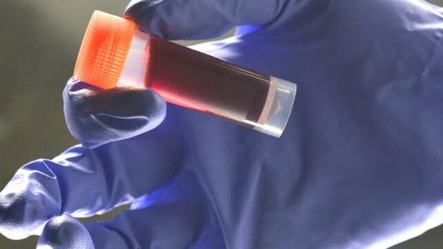 Група крові впливає на ризик раннього інсульту, показує дослідження